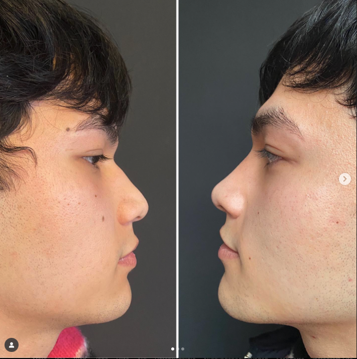 Nasenkorrektur Vorher-Nachher Behandlung