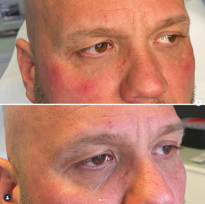 Augenbereich Vorher-Nachher Behandlung